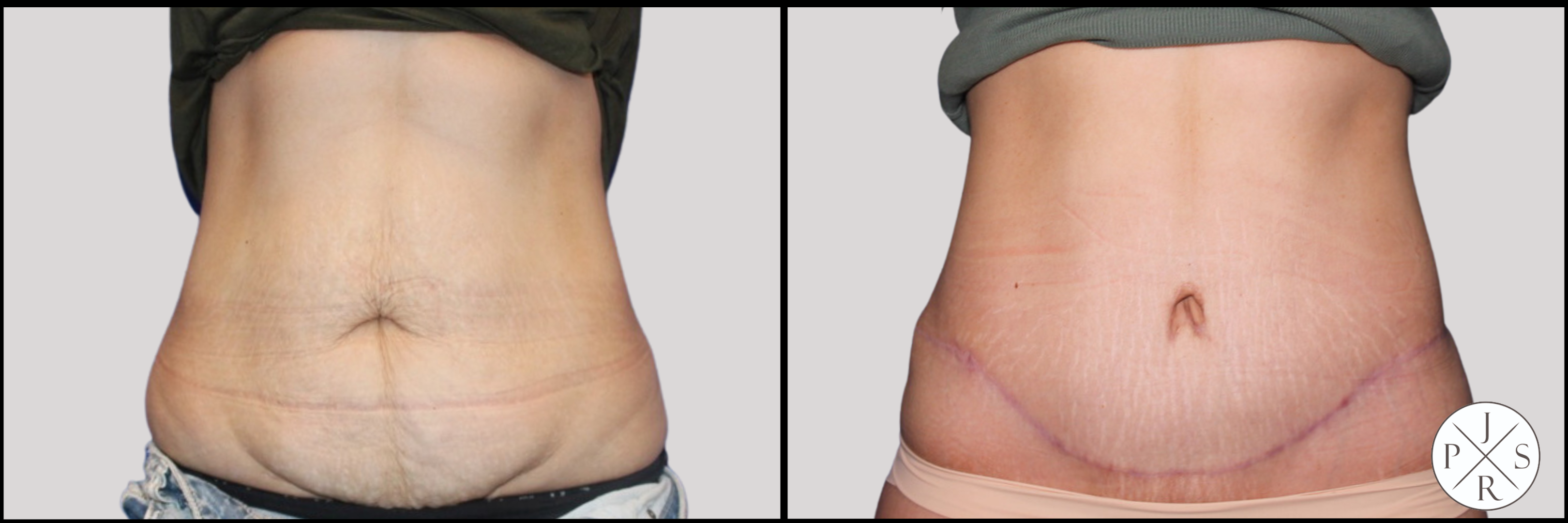 Abdominoplasty Before & After Image